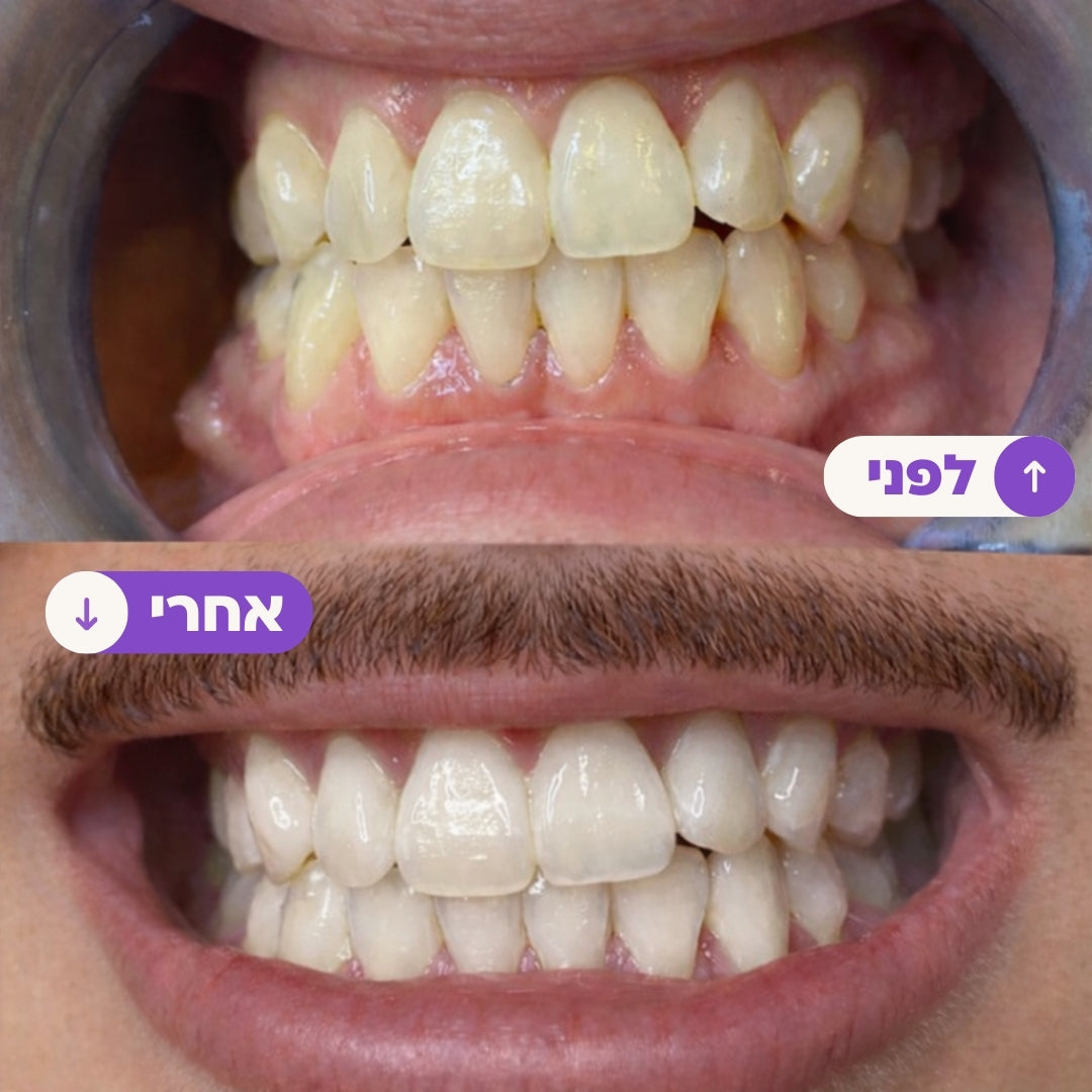 רצועות הלבנה סגולות להלבנה מיידית