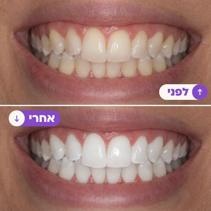 רצועות הלבנה סגולות להלבנה מיידית